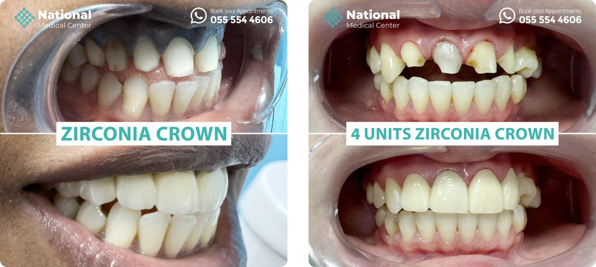 Dental-Crown-in-Dubai