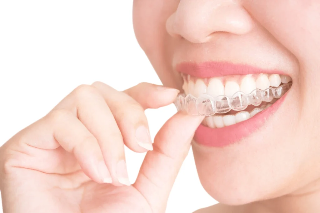 Best Aftercare Tips for Clear Aligners