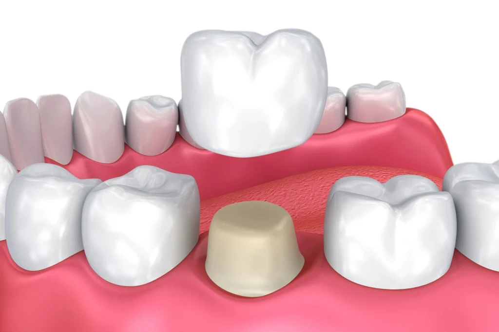 Aftercare Tips for Dental Crowns and Bridges