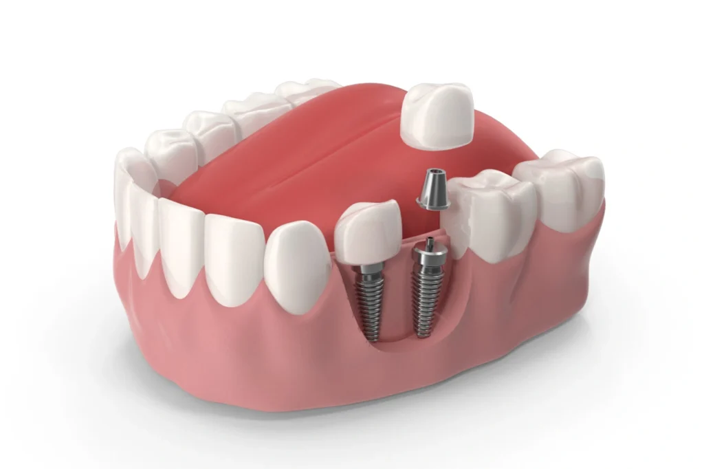 Proper Dental Implant Care: Essential Aftercare Tips